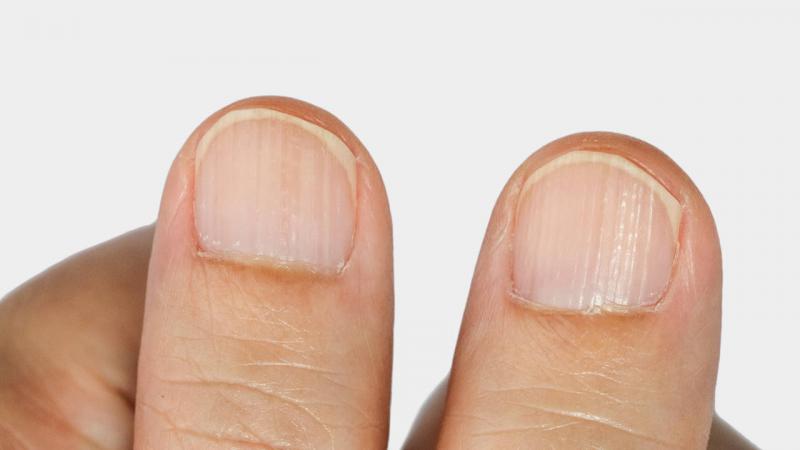 U&ntilde;as con rayas y l&iacute;neas: causas y significados