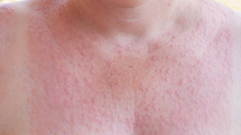 Alergia al sol: qu&eacute; es, s&iacute;ntomas y remedios naturales