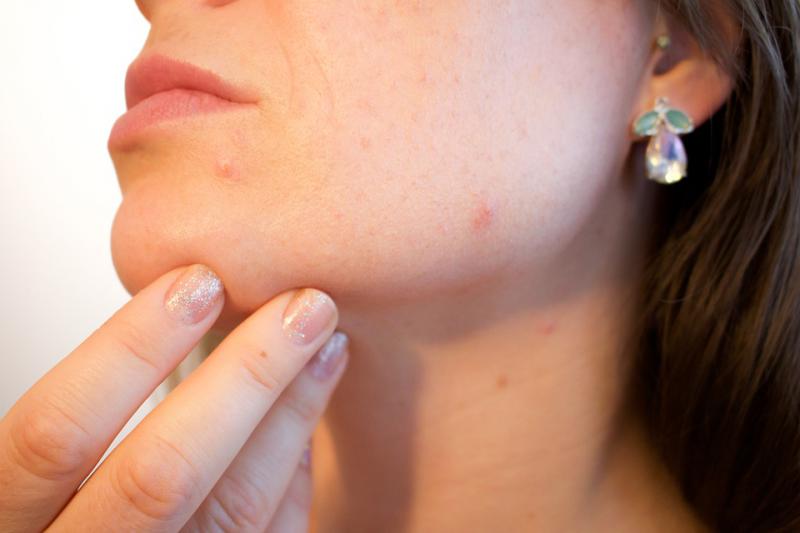  Mascarillas naturales: lo que debes saber para eliminar marcas de acn&eacute; y cicatrices