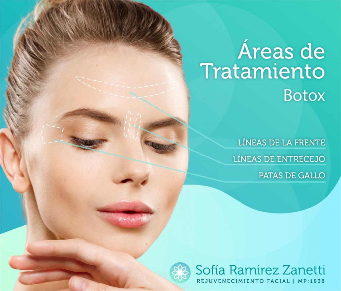 Rejuvenecimiento Facial: Botox